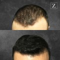 How ARTAS Hair Transplant Revolutionizes Hairstyling In The Bay Area