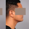 Say Goodbye To Neck Fullness For Better Hairstyling: Neck Liposuction NYC