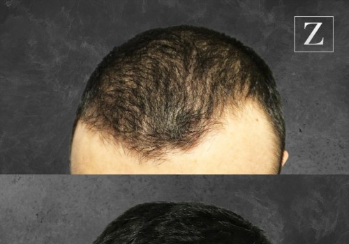 How ARTAS Hair Transplant Revolutionizes Hairstyling In The Bay Area